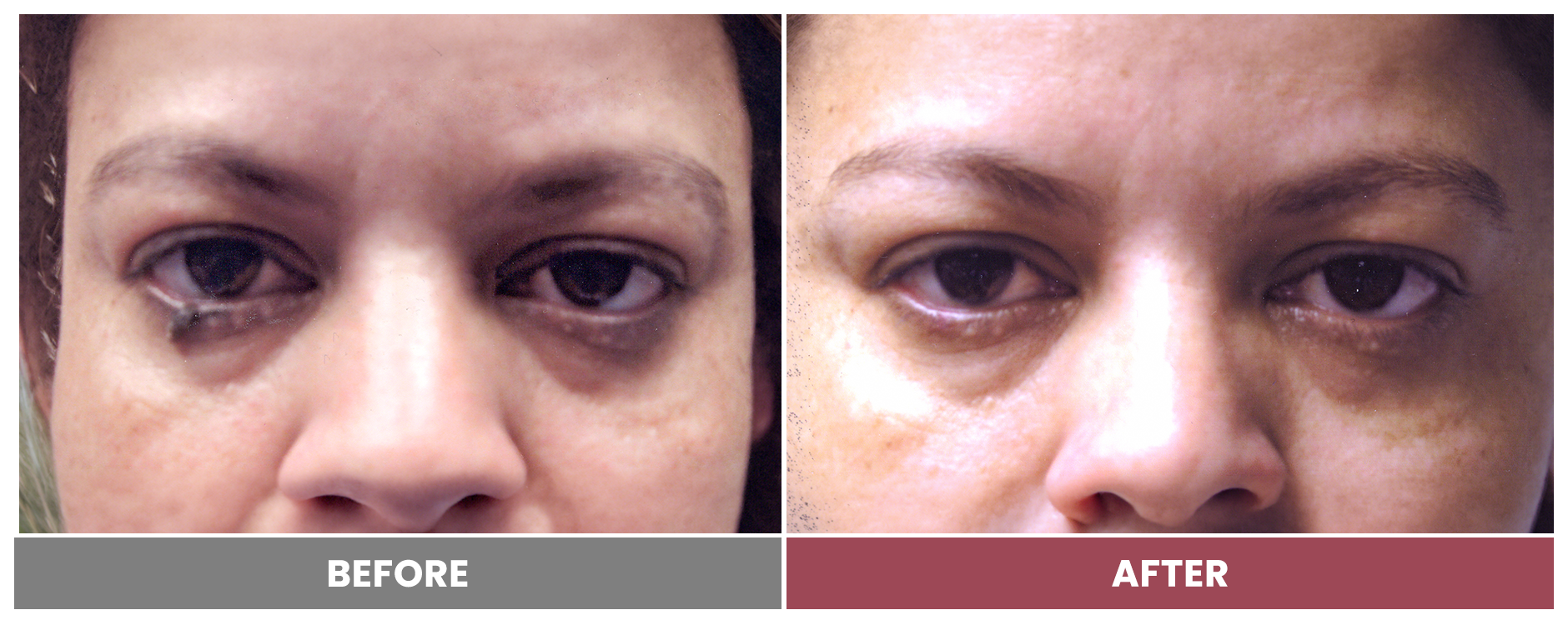 TUMOR REMOVAL AND RECONSTRUCTION - Case 16
